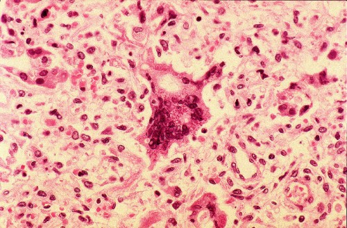 Riesenzelle bei einer Masern-Pneumonie (Bild: CDC/ Dr. Edwin P. Ewing, Jr., Public Domain)